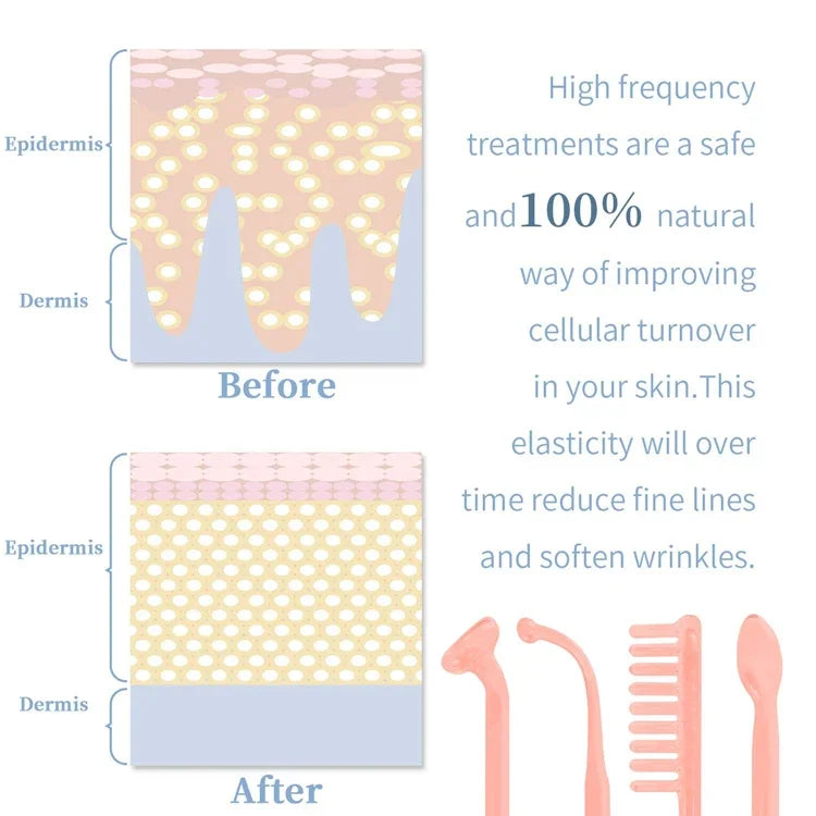 Acne Treatment Machine